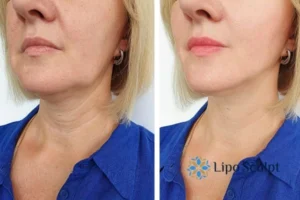 Double chin before and after Hi-Fu treatment 4 Book your double chin treatment Bicester today! We are here to help!