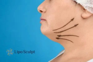 Double chin before and after Hi-Fu treatment 3 Boost your confidence with a Double chin treatment Bicester