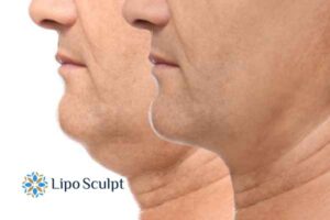 Double chin before and after Hi-Fu treatment 2 Double chin treatment Bicester from Lipo Sculpt - feel more confident today!