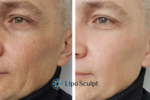 How to Fight Aging Symptoms 3 Fight Aging Symptoms Bicester With HIFU and Morpheus8 Today!