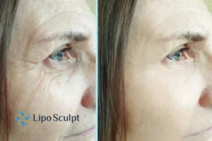 How to Fight Aging Symptoms 2 Do you want to Fight Aging Symptoms Bicester? Contact Lipo Sculpt today!