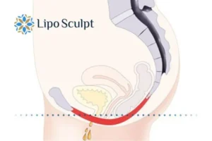 Pelvic Floor Chair Therapy 1 Pelvic Floor Chair Therapy Bicester to treat incontinence.