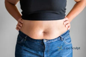 Bidding Farewell to Muffin Tops with Aqualyx Fat Injections 2 Do you wish you could reduce your muffin top Bicester With Aqualy fat dissolving injections you can!